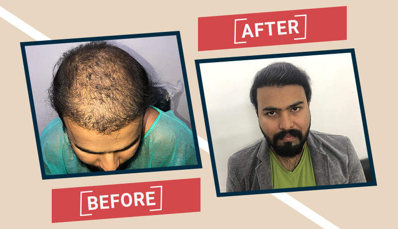 Before-After Hair transplant karachi (1)