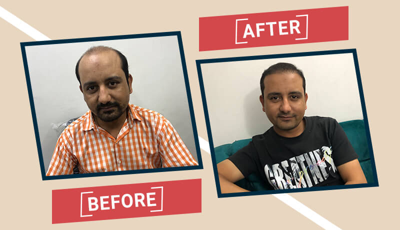 Before-After Hair transplant karachi (4)