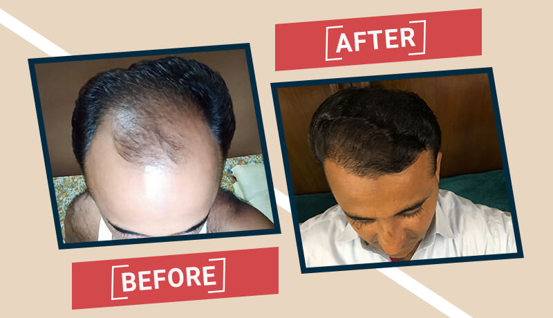 Before-After Hair transplant karachi (5)
