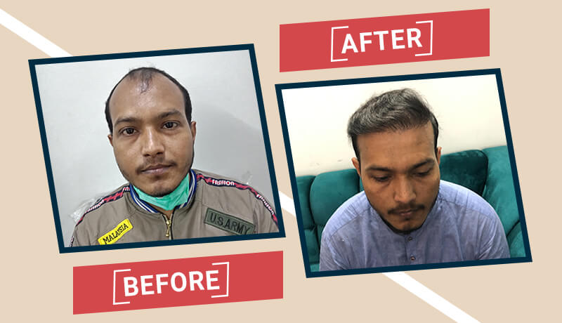 Before-After Hair transplant karachi (6)