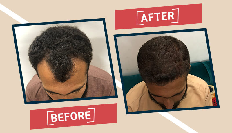 Before-After Hair transplant karachi (7)
