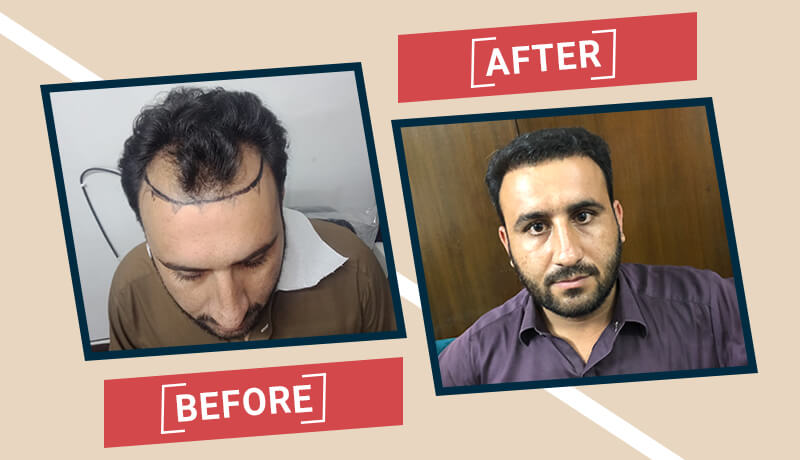 Before-After Hair transplant karachi (8)