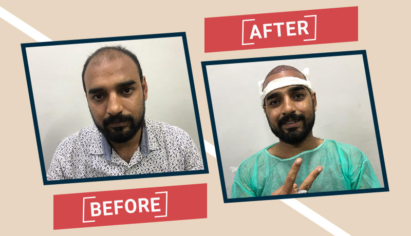Before-After Hair transplant karachi (9)