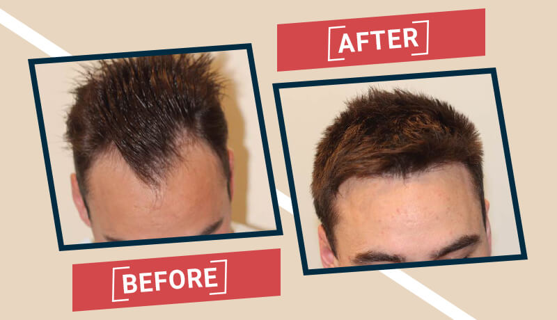 Before-After Hair transplant karachi